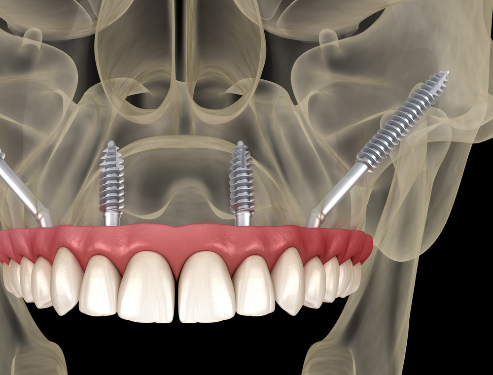 implant dentar