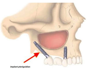 implant dentar