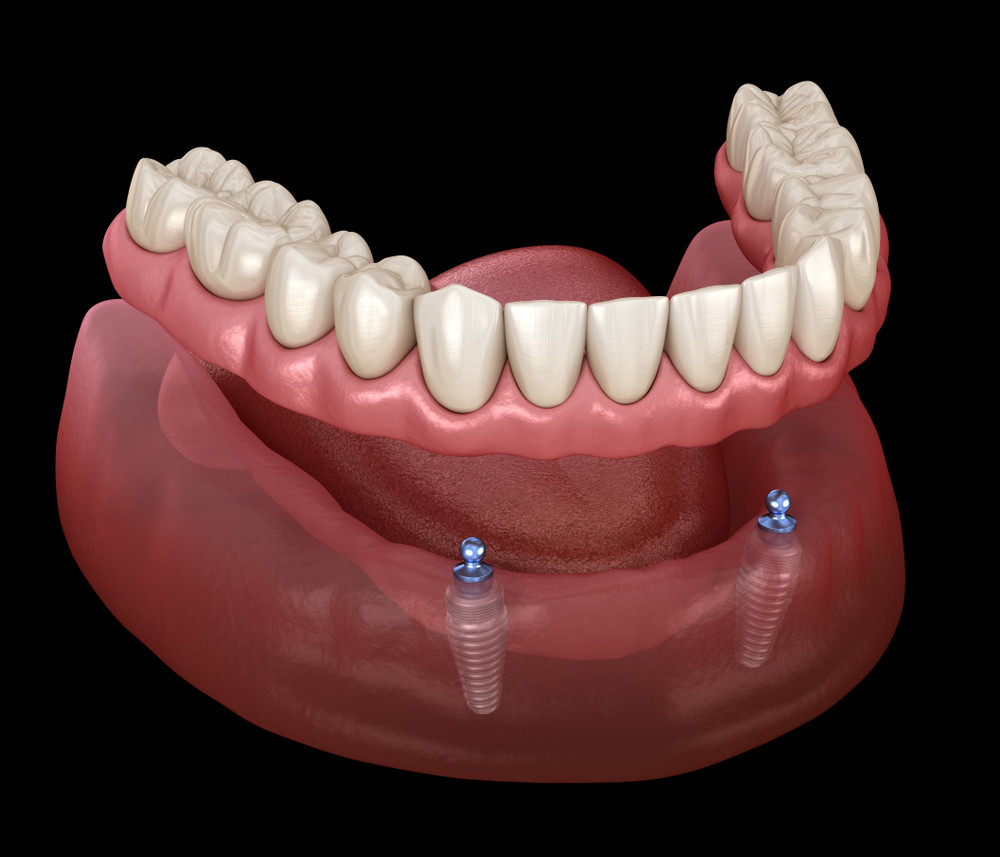 implant dentar