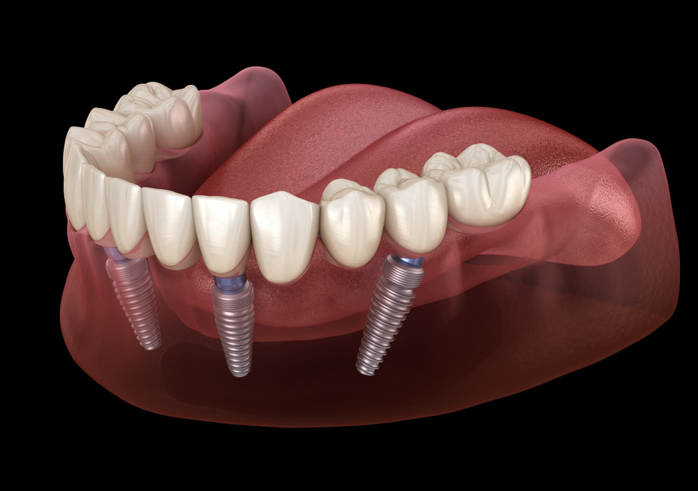 implant dentar