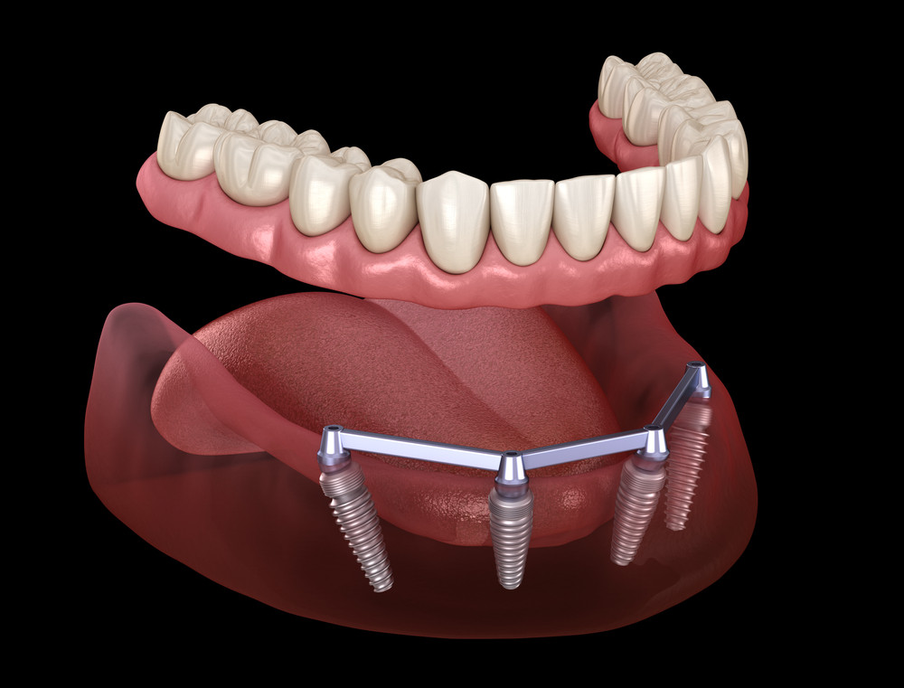 implant dentar