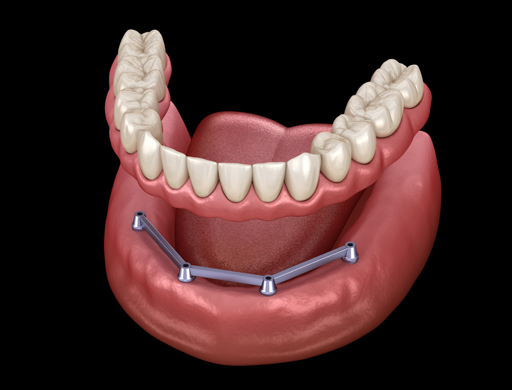 implant dentar