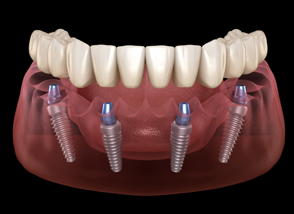 implant dentar