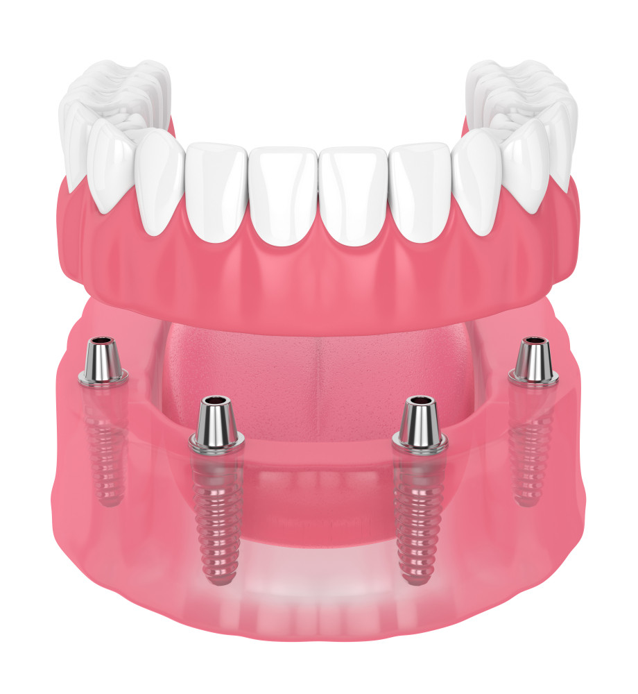 implant dentar