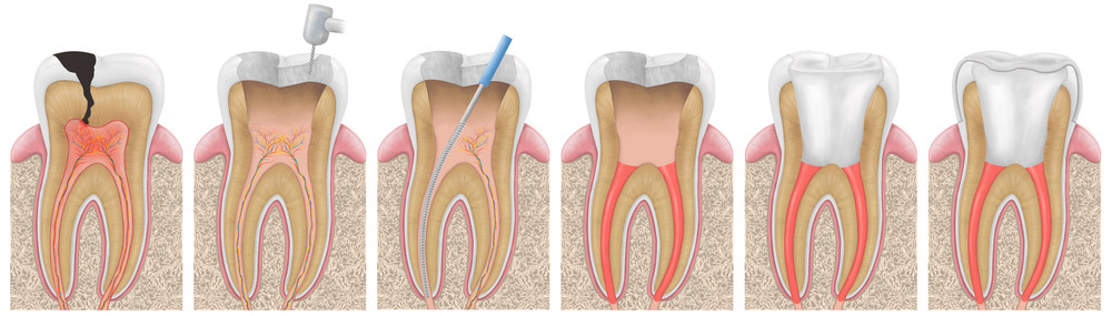 tratament de canal, endodontie