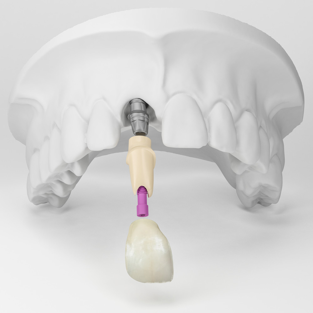 implant dentar