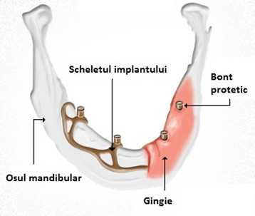 implant dentar